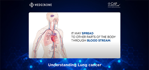 Understanding Lung cancer | MedGenome